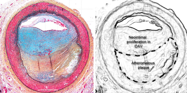 CAV and atherosclerosis Movat